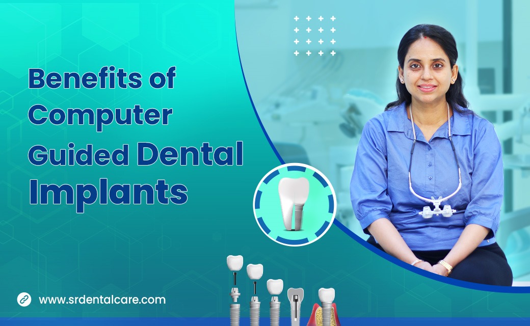 Benefits of Computer Guided Dental Implants